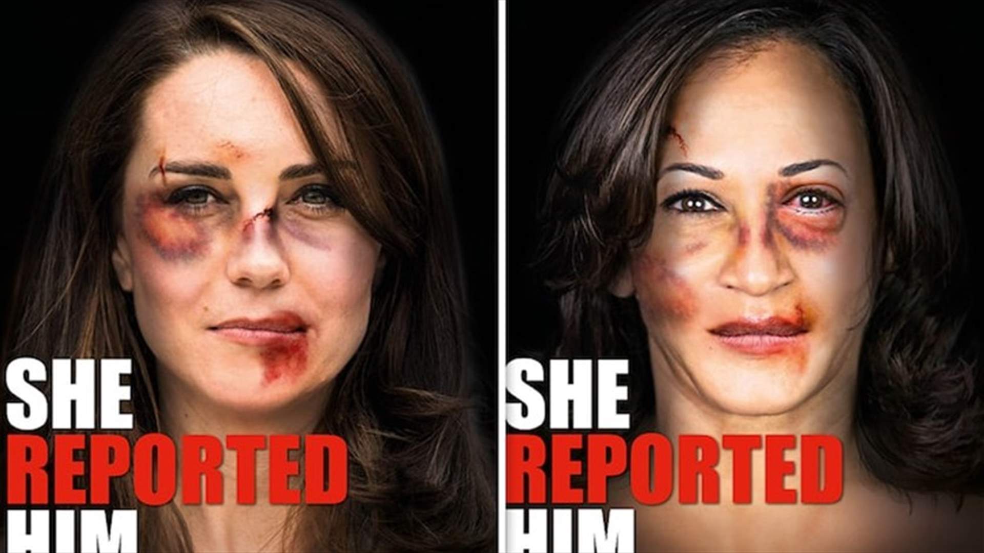 جروح وكدمات على وجه كيت ميدلتون... ورسالة لإنهاء العنف ضد المرأة (صور)