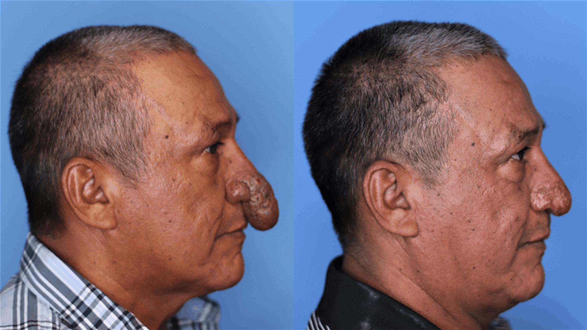 &quot;أرسل الله لي ملاكاً&quot;... صاحب أغرب أنف في العالم يخضع لعملية تجميل غيّرت حياته! (صورة)