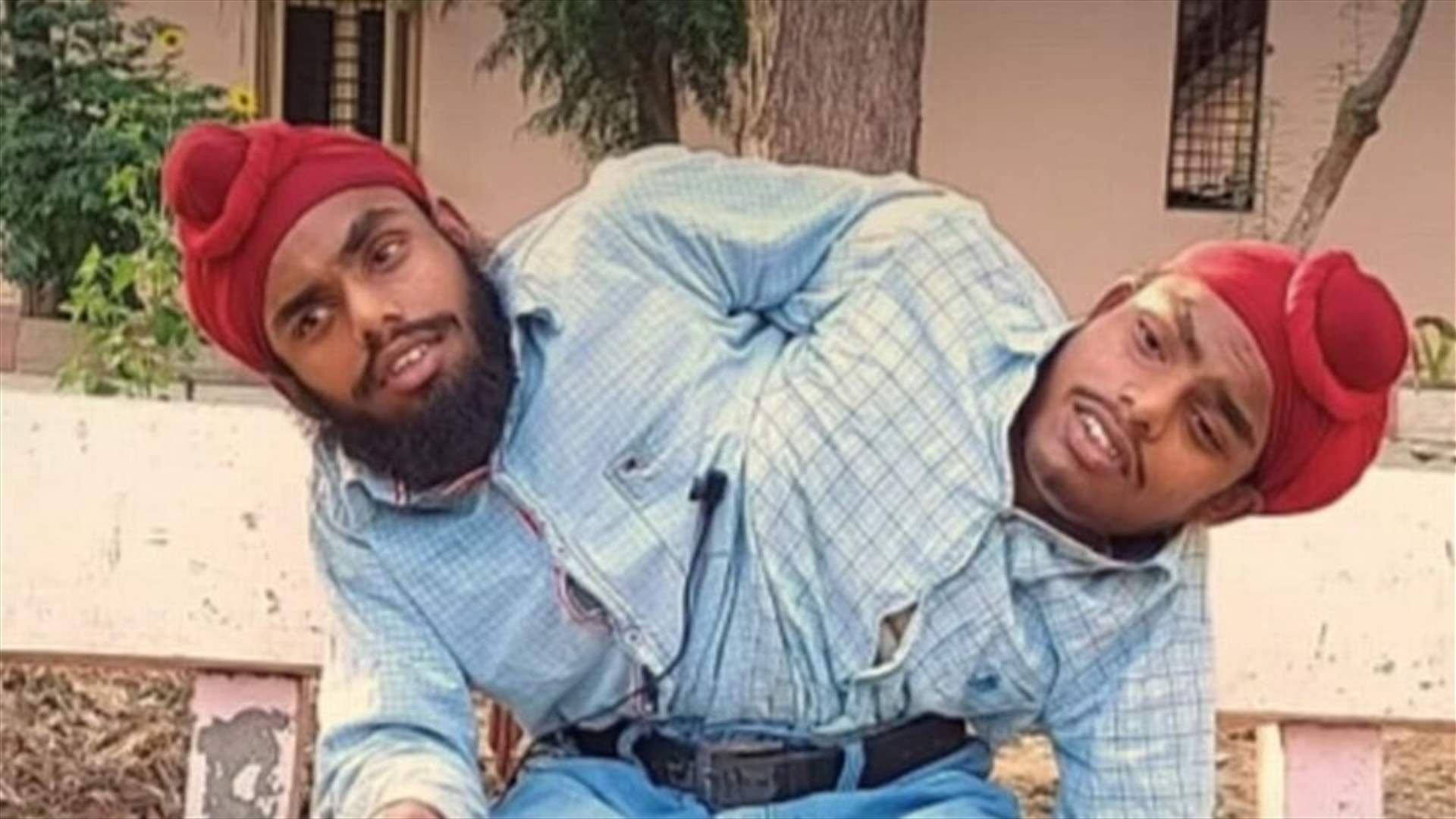 توأم ملتصق يحصل على وظيفة الأحلام بعد سنواتٍ من العذاب (صور)