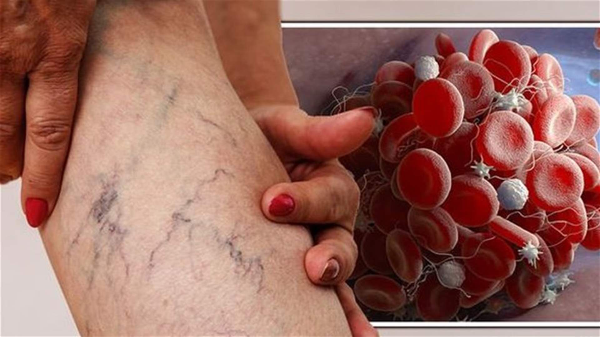 إحذروا هذه العلامات... قد تشير إلى التجلط الدموي في الساق!