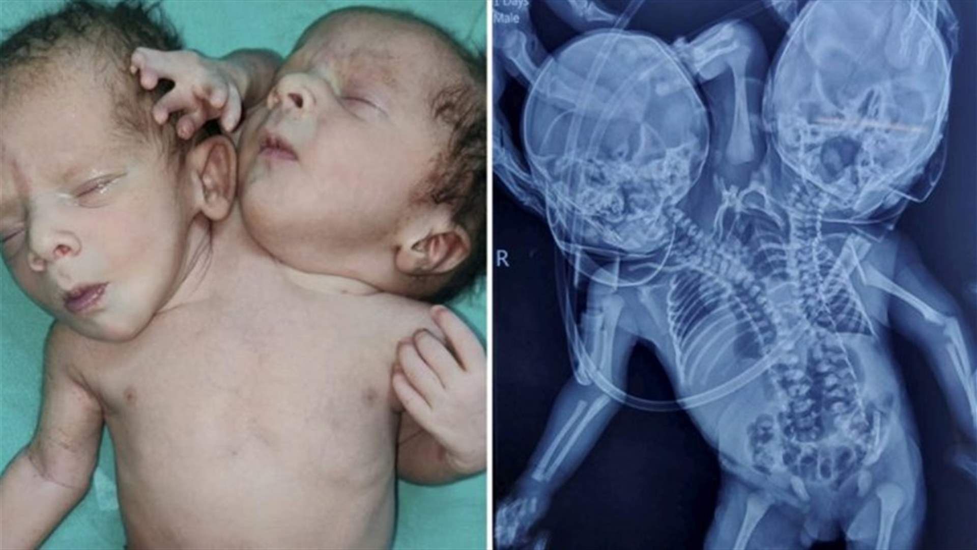 "الطفل المعجزة"... ولادة رضيع برأسين وثلاثة أذرع في الهند!