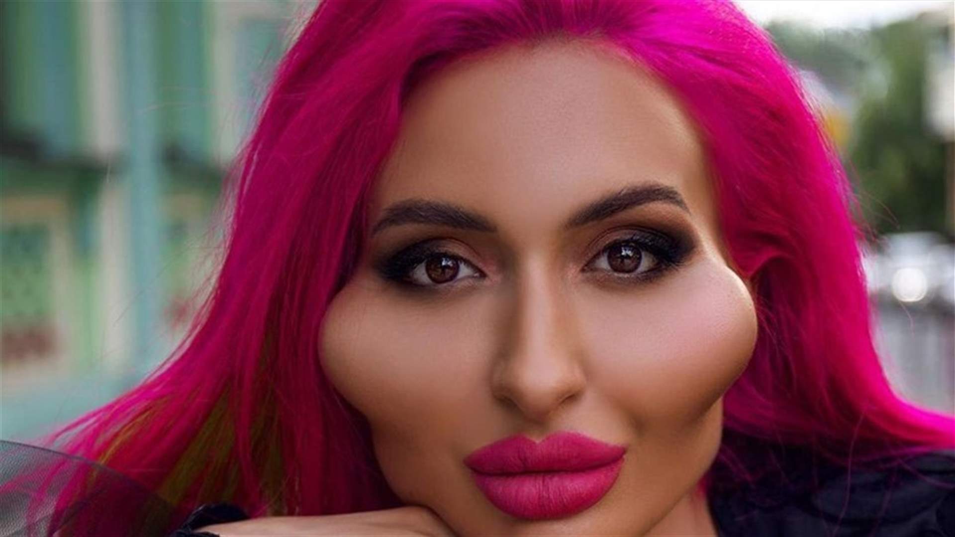صاحبة "أكبر وجنتين في العالم" تتمسك بلقبها... وثّقت لحظة حقنها بالمزيد من البوتوكس!