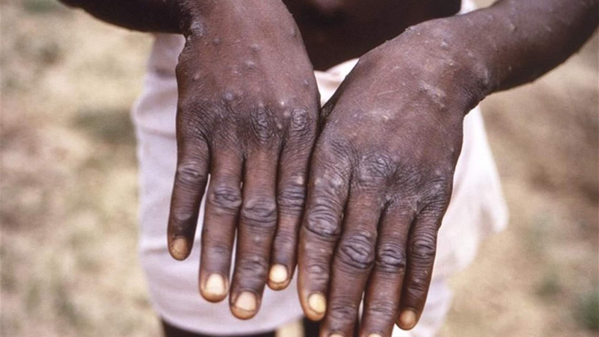 منظمة الصحة العالمية تعلن أكثر من 5 آلاف إصابة بجدري القردة في العالم
