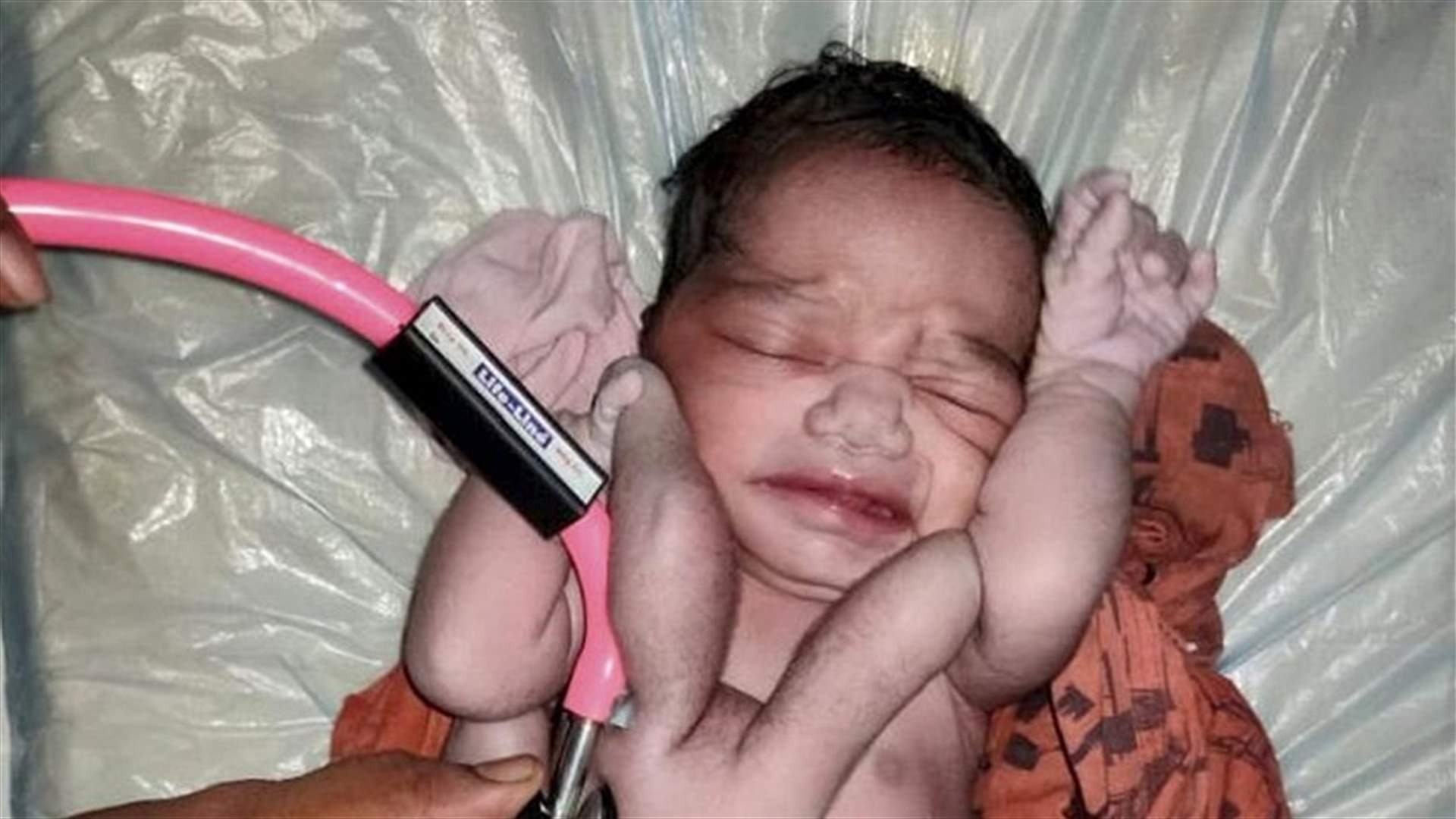 &quot;معجزة الطبيعة&quot;... ولادة طفل بأربعة أذرع وأرجل في الهند (صور)
