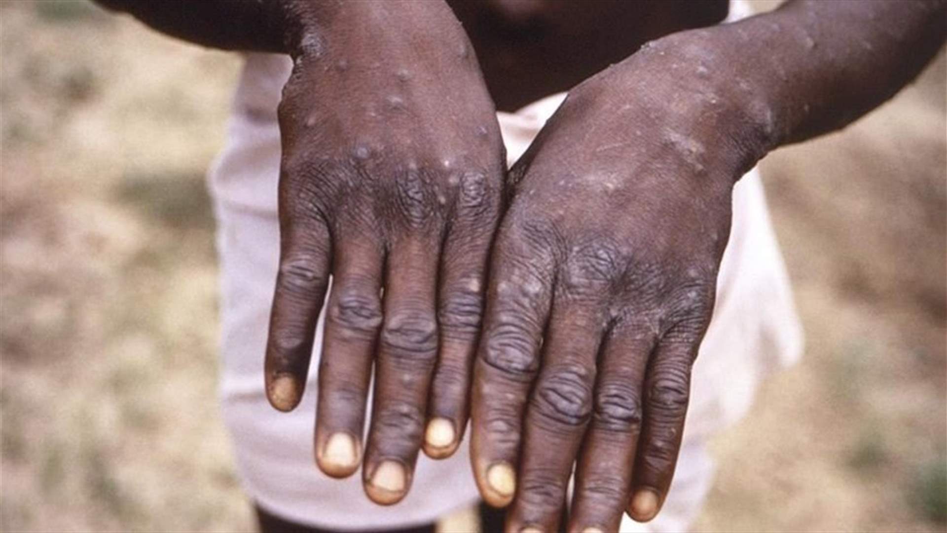 WHO: Monkeypox cases top 5,000