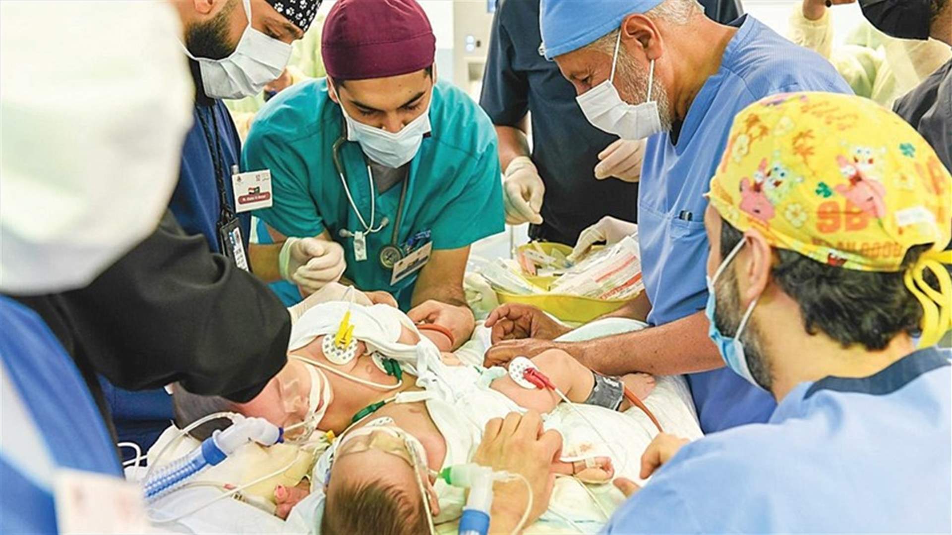 في السعودية... نجاح عملية فصل التوأم السيامي اليمني &quot;مودة ورحمة&quot;