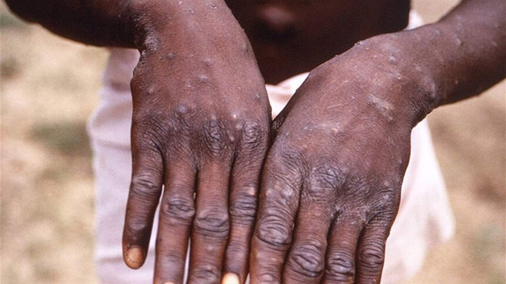 منظمة الصحة العالمية تتوقع وفيات أخرى بجدري القردة في أوروبا
