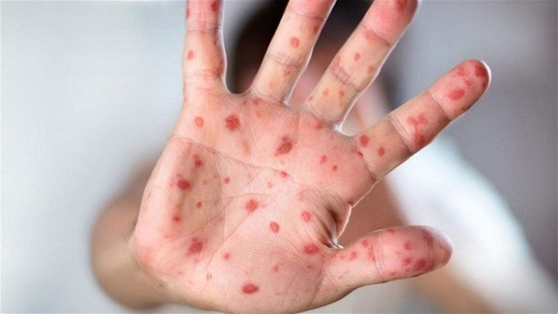 لتفادي الوصمة ...منظمة الصحة العالمية تطلب اقتراح أسماء بديلة لجدري القردة