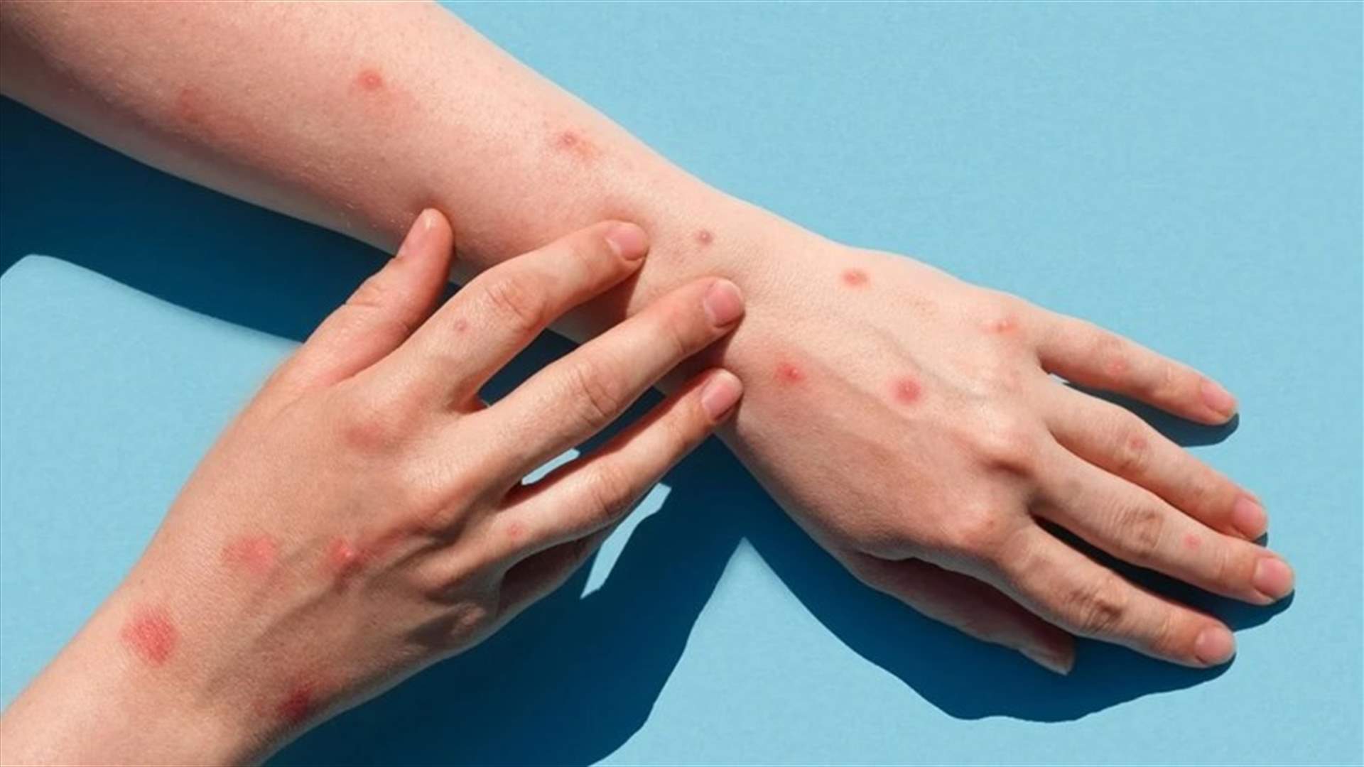 بالنسبة لمرضى جدري القردة...وصمة العار والتداعيات النفسية أكثر تأثيرا من الطفح الجلدي!