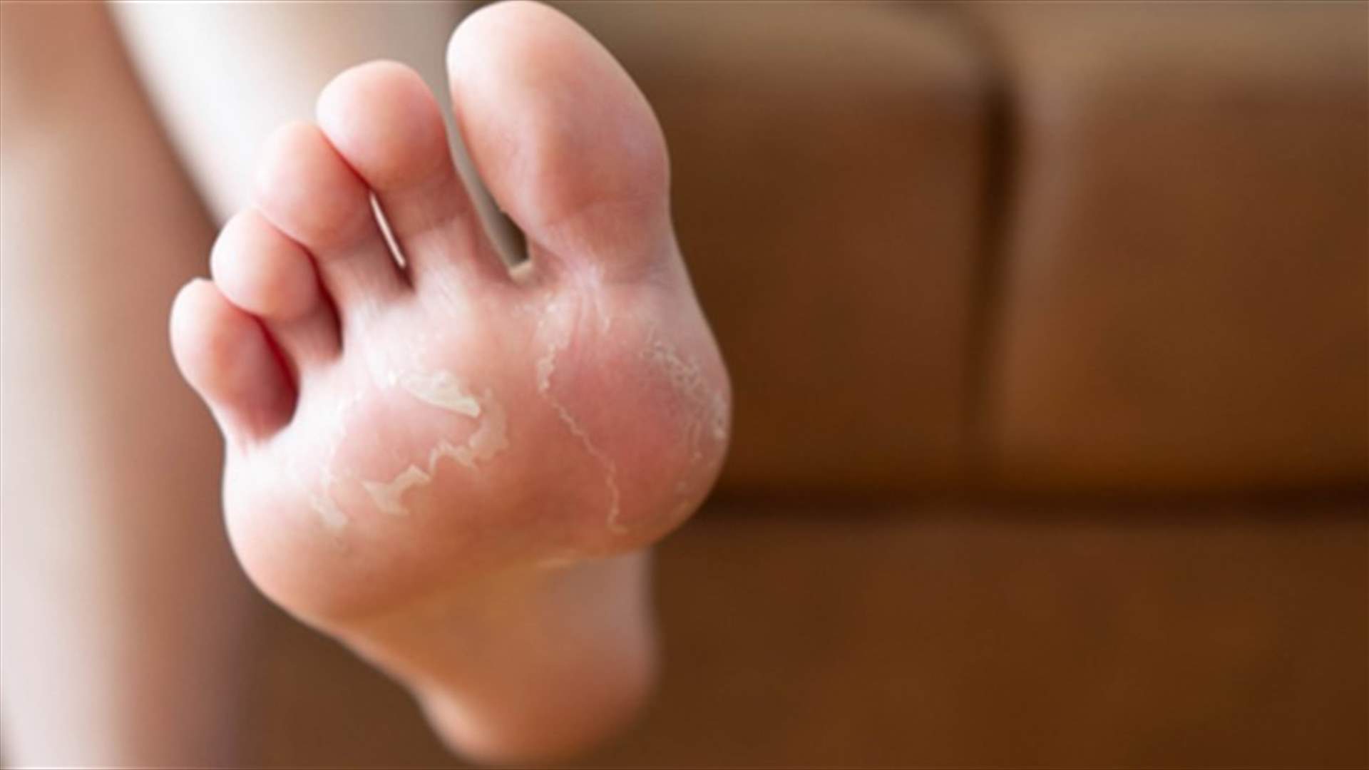تقشر القدمين... معلومات مهمة عن الأسباب والعلاج لا تتجاهلوها!
