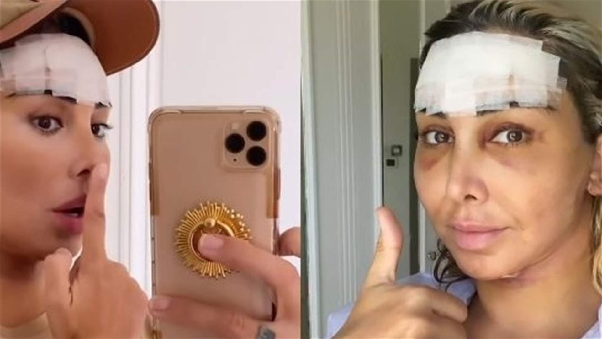جويل ماردينيان توثق عملية شدّ وجهها.. استغرقت 11 ساعة في غرفة العمليات! (فيديو)