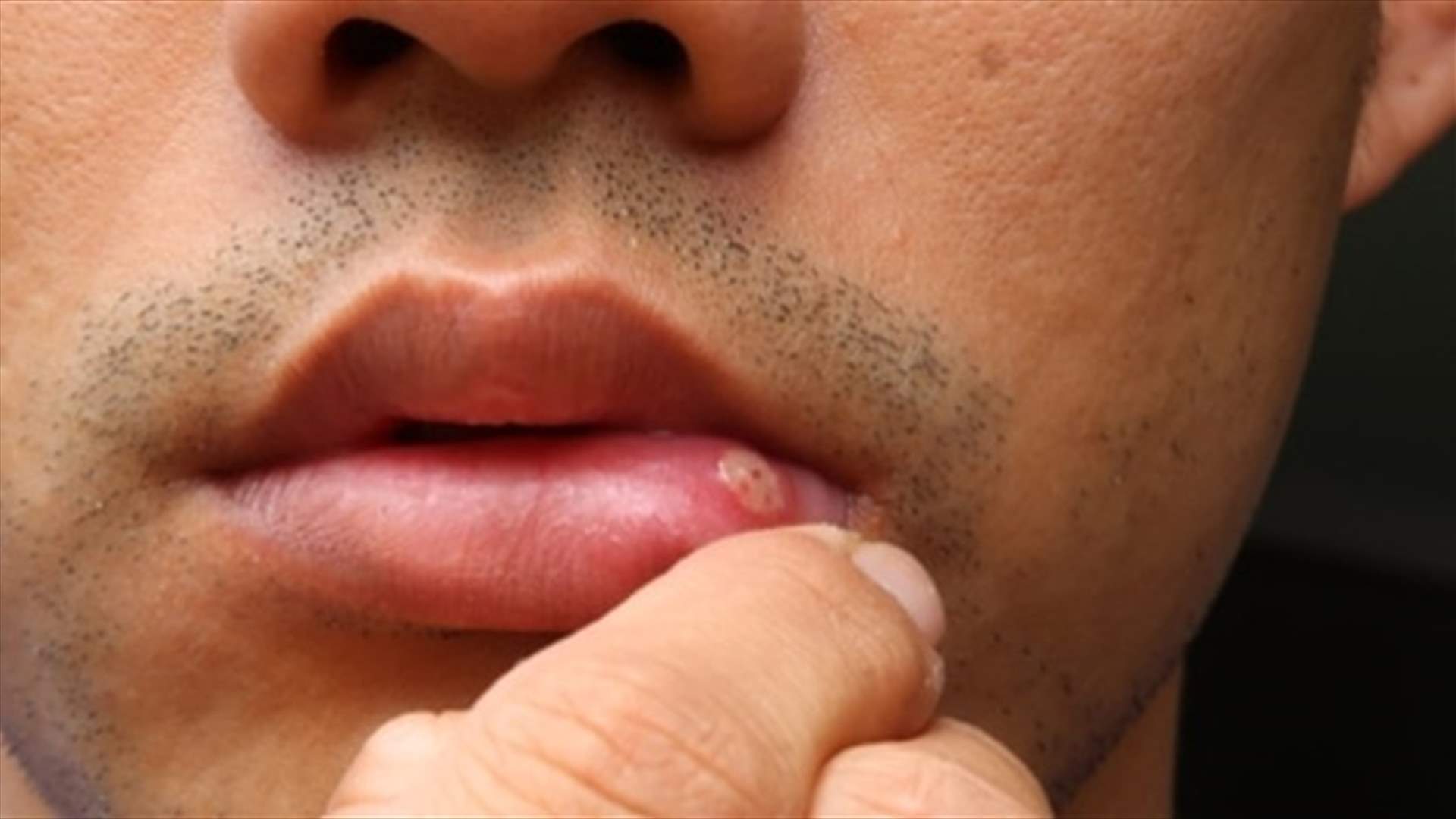 سرطان الشفاه... ما هي أعراضه؟