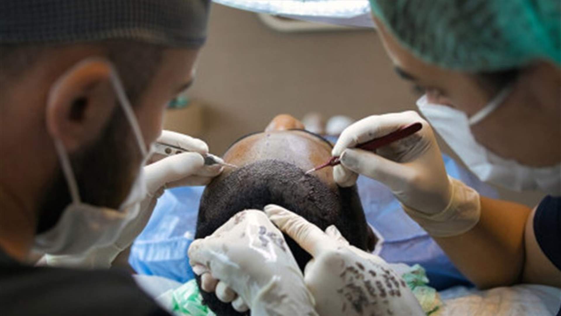 نهاية مأساوية... عملية زرع شعر تودي بحياة شاب في الهند