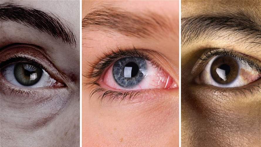 6 أمور صحيّة يمكنكم معرفتها من لون عيونكم