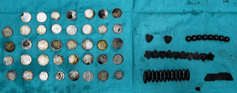 لسبب غريب جدا... رافع أثقال أكل 39 عملة معدنية و37 مغناطيسا وهذا مصيره! (صور)