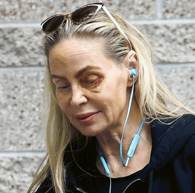 ابن نجم هوليوودي متهم بضرب والدته... عين سوداء وكدمات على الوجه (صورة)