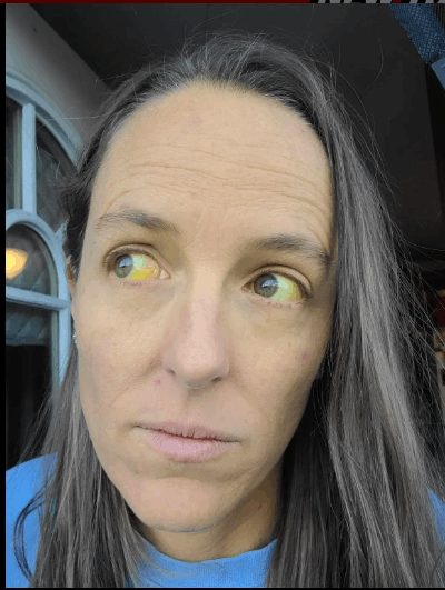 علاج عشبي لانقطاع الطمث كاد أن يودي بحياتها... اصفرار مرعب اجتاح وجهها وعينيها: اليكم ما حصل معها! (صور)