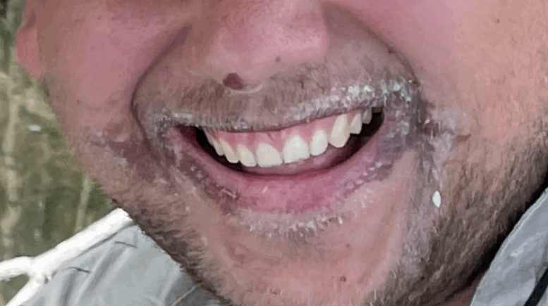 أصيت بحروق من الدرجة الثالثة في وجهه بعد تناول هذه الفاكهة! (صورة)