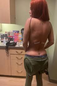 أرادت خصرا صغيرا مثل كيم كارداشيان... شابة تخوض تجربة مليئة بالمخاطر وهذه النتيجة! (صورة)