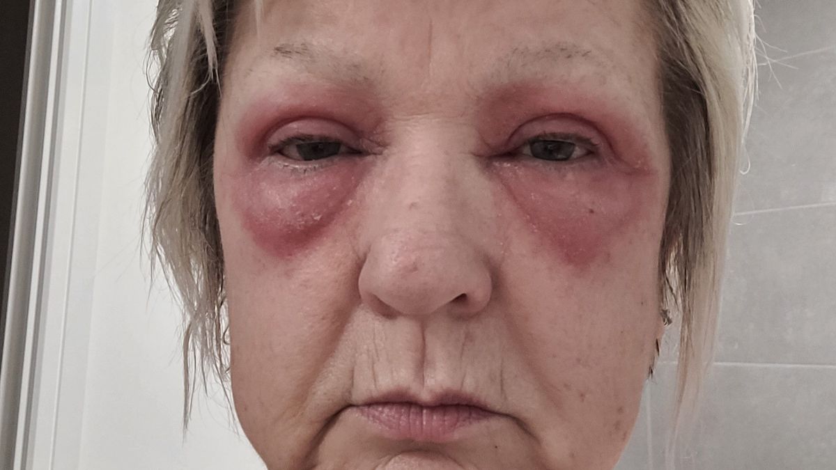 بقع حمراء اكتسحت وجهها... ما عانت منه امرأة ستينية مروع: الحل كان بسيطا بشكل لا يصدق! (صور)