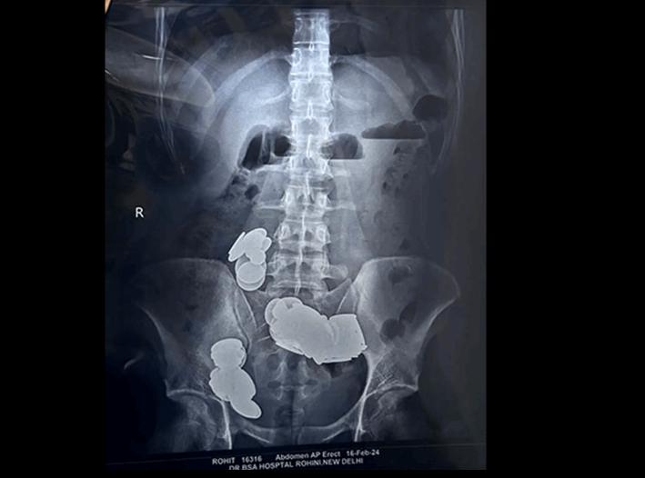 لسبب غريب جدا... رافع أثقال أكل 39 عملة معدنية و37 مغناطيسا وهذا مصيره! (صور)