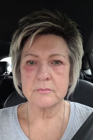 بقع حمراء اكتسحت وجهها... ما عانت منه امرأة ستينية مروع: الحل كان بسيطا بشكل لا يصدق! (صور)