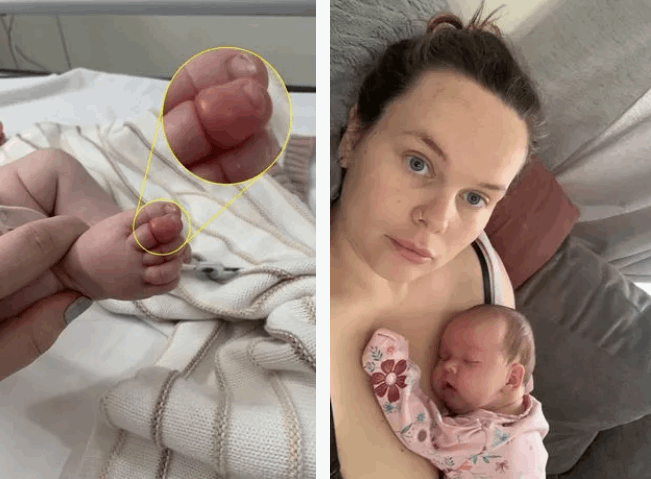 التف حول إصبعها خصلة من شعر والدتها... معاناة عاشتها رضيعة وهذه النتيجة (صورة)