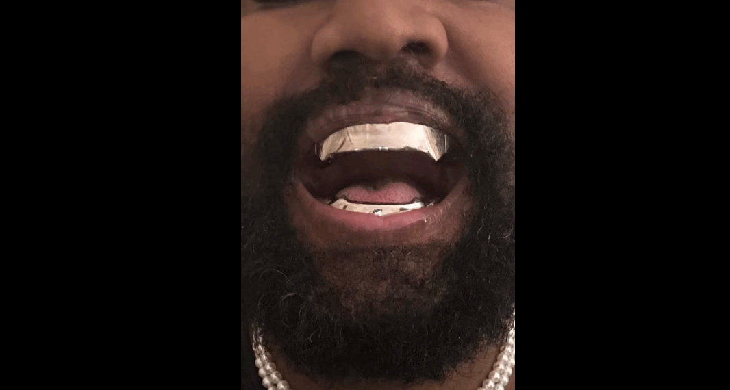 أزال أسنانه واستبدلها بأخرى أغلى من الألماس ... كاني ويست يشعل الإنترنت بمظهره الجديد! (صور)