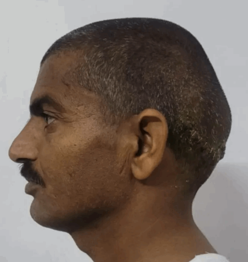 ورم بحجم البطيخة نما برأسه لمدة 15 سنة... رجل برأسين خضع لجراحة دقيقة: عاني من ضرر بالجمجمة وهذا مصيره! (صور)