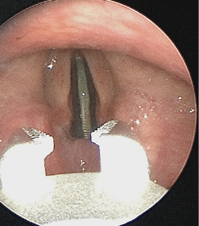 طفل ابتلع 25 سنتا... وهذه كانت النتيجة! (صور)