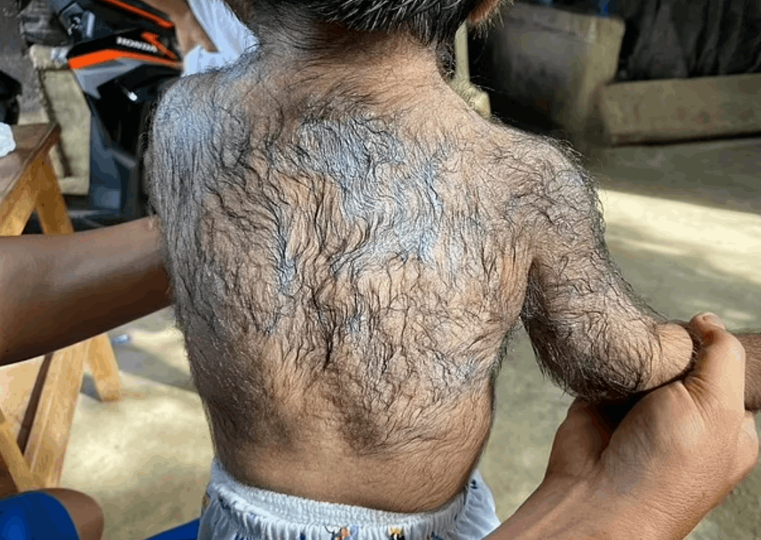 أكلت القطط البرية خلال حملها... ابنها ولد مصابا بـ متلازمة المستذئب : أعتقد أنها لعنة! (فيديو)