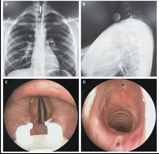 طفل ابتلع 25 سنتا... وهذه كانت النتيجة! (صور)