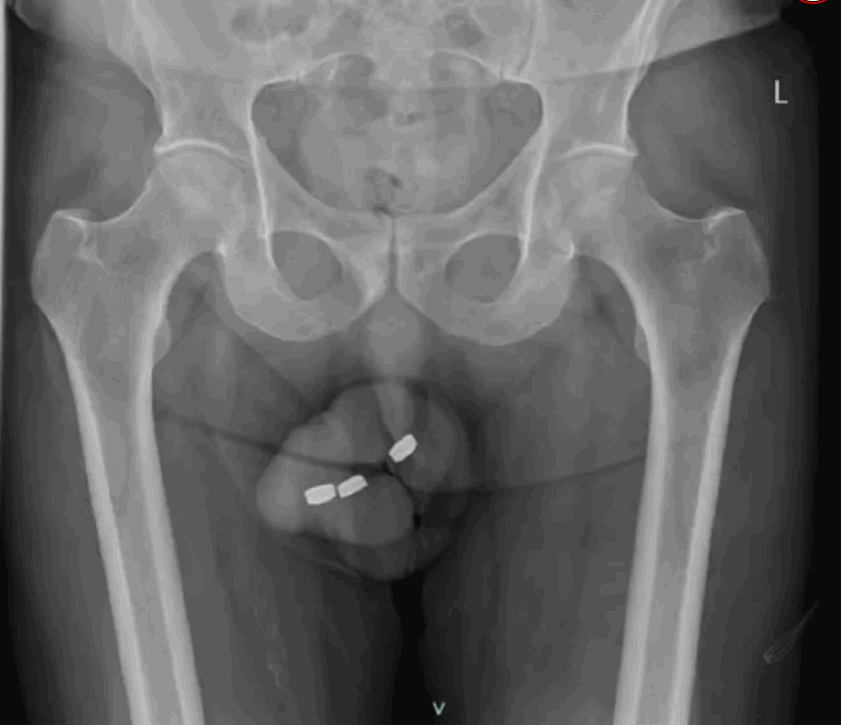 رجل سبعيني أدخل بطاريات في عضوه التناسلي... ما حصل بعد ذلك كارثي! (صورة)