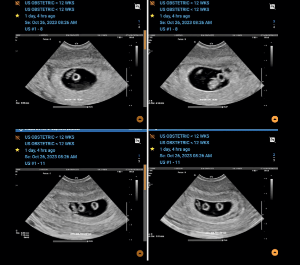 حملها يعتبر معجزة تحصل مرة من أصل كل 70 مليون حالة... أنا أم للمرة الأولى وأنتظر مجموعتين من التوائم المتماثلة !