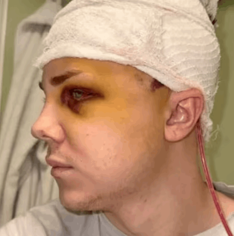 فتحوا جمجمته 4 مرات لغسل دماغه... حادث غامض غير حياته: استبدلوا جمجمتي بشبكة من التيتانيوم ! (فيديو)