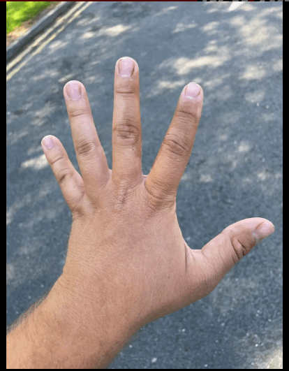 أصيت بحروق من الدرجة الثالثة في وجهه بعد تناول هذه الفاكهة! (صورة)