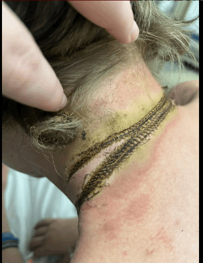 قلادته كادت أن تقتله... أراد التأكد من شحن هاتفه ولكن ما حصل بعدها مرعب: رأيت الشرارات تخرج من رقبتي ! (صور)