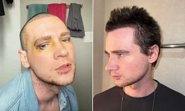 رجل ينفق أكثر من 6000 دولار على عملية زراعة الشعر... تحول مذهل في مظهره! (صورة)