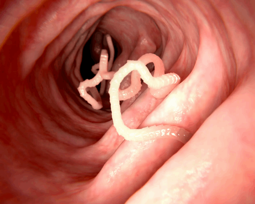 اعتقد أنه يعاني من الصداع النصفي الشديد ولكن ما عثر عليه داخل دماغه صادم! (صور)