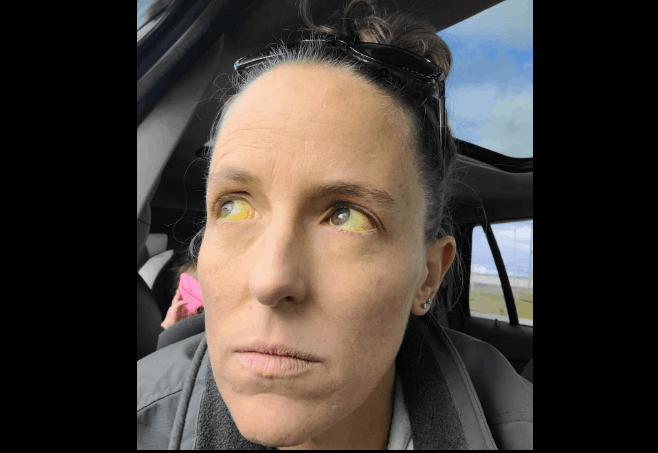 علاج عشبي لانقطاع الطمث كاد أن يودي بحياتها... اصفرار مرعب اجتاح وجهها وعينيها: اليكم ما حصل معها! (صور)