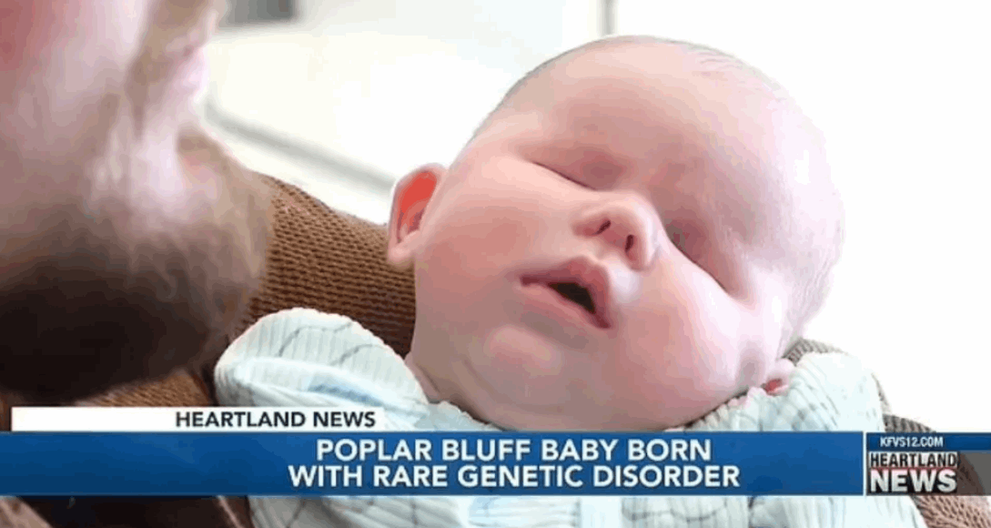 صدمة كبيرة عاشها والدان بعد ولادة طفلتهما... اضطراب وراثي نادر أدى إلى ولادتها من دون عيون! (صورة)