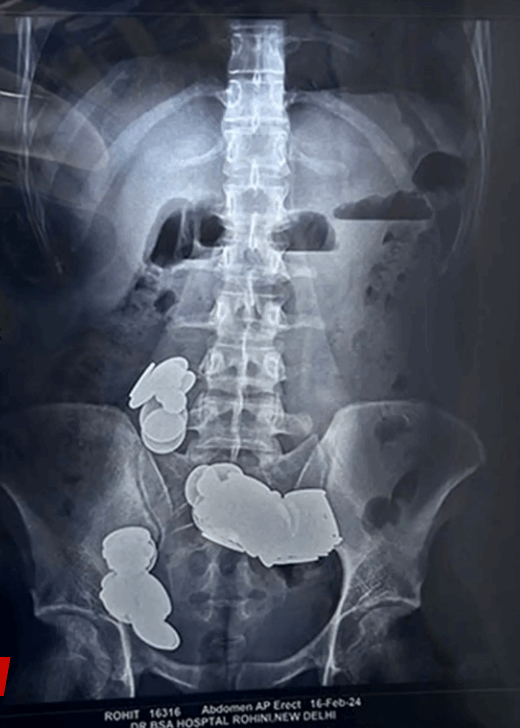 لسبب غريب جدا... رافع أثقال أكل 39 عملة معدنية و37 مغناطيسا وهذا مصيره! (صور)