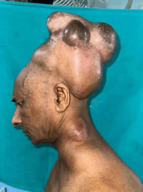 وزنه تخطى الـ7 كلغ... رجل خمسيني عاش مع ورم خارجي ضخم في رأسه لـ25 سنة: إليكم ما حدث! (صور)