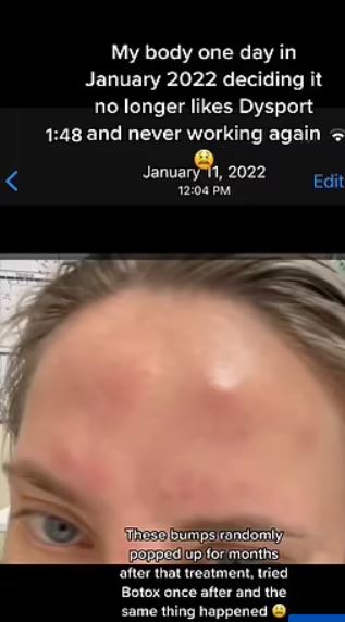امرأة أميركية تروي تجربتها مع الآثار الجانبية لحقن البوتوكس... ما أصابها بعد ثماني سنوات من روتينها المنتظم صادم! (صور)