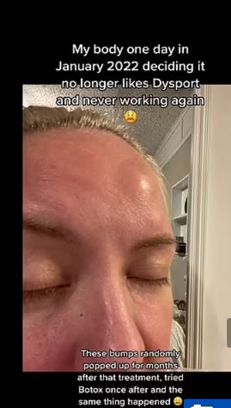 امرأة أميركية تروي تجربتها مع الآثار الجانبية لحقن البوتوكس... ما أصابها بعد ثماني سنوات من روتينها المنتظم صادم! (صور)