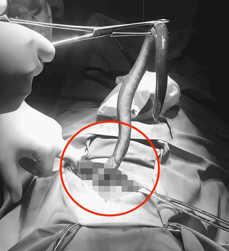 دخل من منطقة الشرج واستقر في جهازه الهضمي... العثور على مخلوق حي كبير داخل جسم رجل ثلاثيني! (صور)