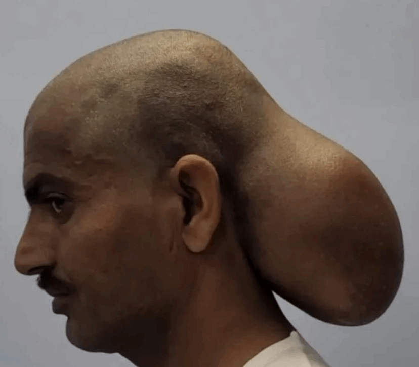 ورم بحجم البطيخة نما برأسه لمدة 15 سنة... رجل برأسين خضع لجراحة دقيقة: عاني من ضرر بالجمجمة وهذا مصيره! (صور)