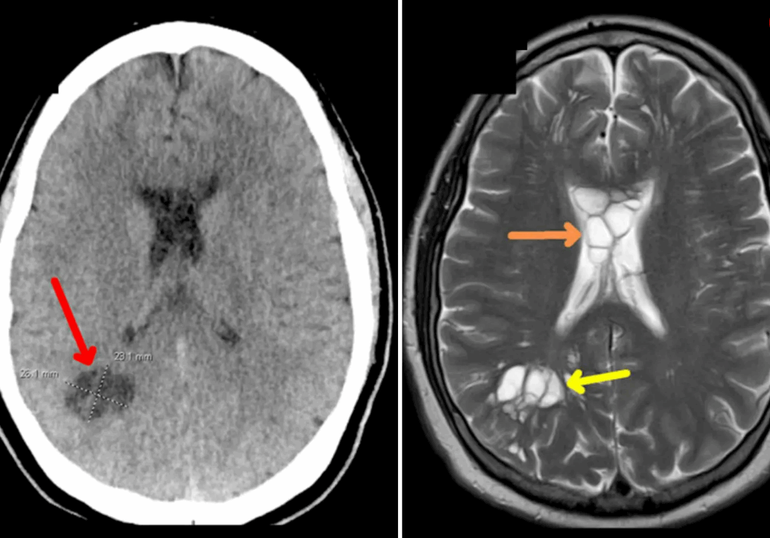 اعتقد أنه يعاني من الصداع النصفي الشديد ولكن ما عثر عليه داخل دماغه صادم! (صور)