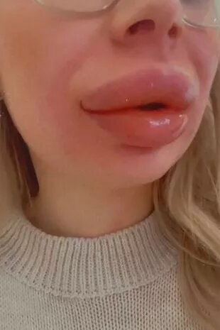 بعد قرارها بإزالة الحشو من شفتيها... شابة كادت أن تفقد حياتها لهذا السبب! (صور)