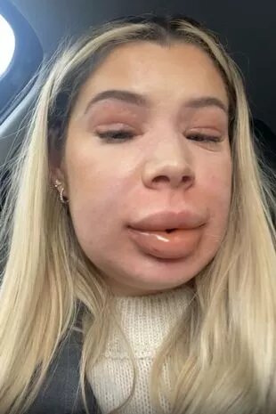 بعد قرارها بإزالة الحشو من شفتيها... شابة كادت أن تفقد حياتها لهذا السبب! (صور)